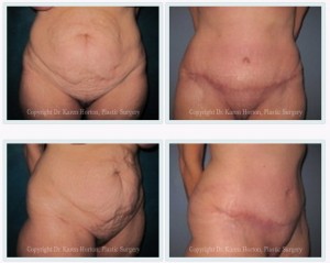 tummy tuck1