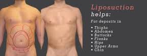 male lipo7