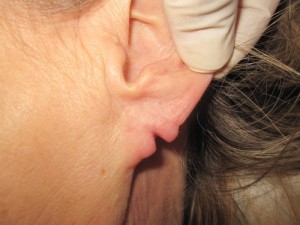 torn earlobe lobul