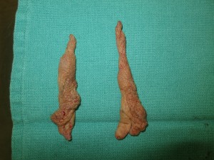 tissue excised during labiaplasty (2)