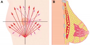 fat grafting to breast image