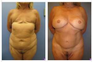 before after DIEP flap reconstruction Horton patient