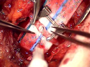 Blood vessels being reconnected under the operating microscope during a Reconstructive Microsurgery procedure