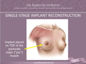 Coupling a Superficial Vein in DIEP Flaps to an Axillary Vessel before Internal Mammary Anastomoses Reduces Venous Complications with Minimal Increased Operative Time 011816 FINAL