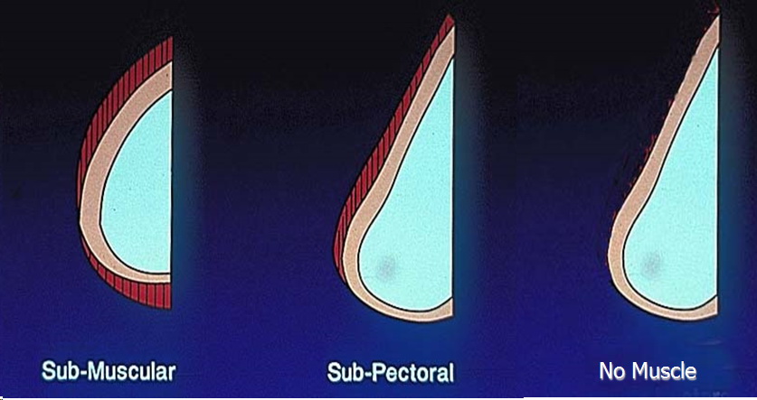 breast implant recon placement diagram