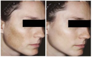 melasma-before-after