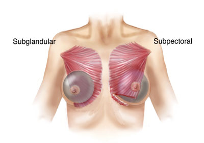 subglandular vs. subpectoral