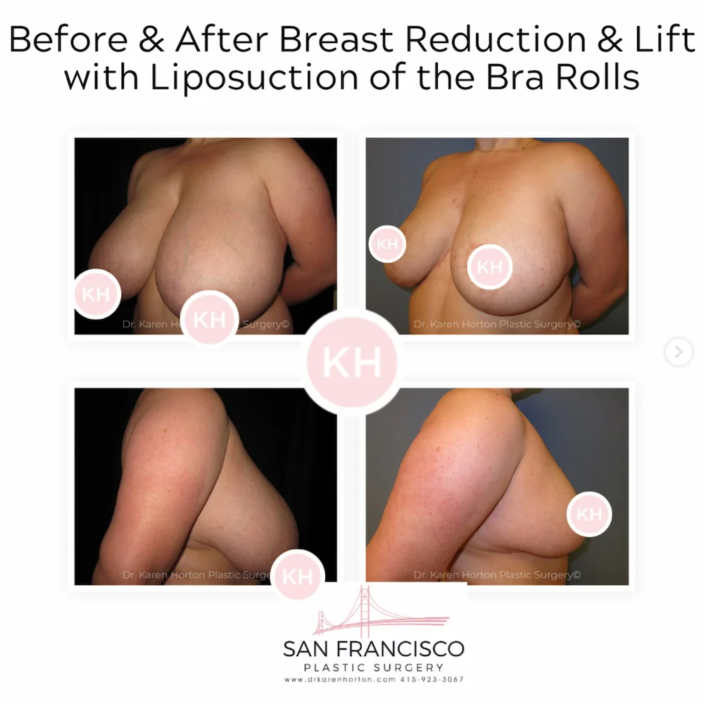 Before and after photos of breast reduction and lift of Bra Rolls